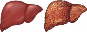 Liver cirrhosis